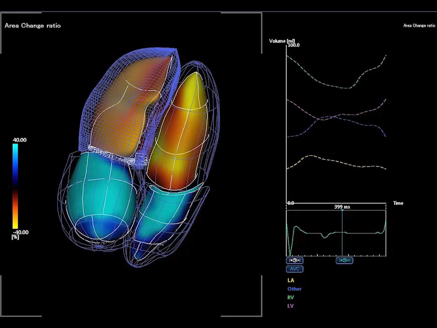 4D визуализация камер сердца с количественным анализом изменения объемов.